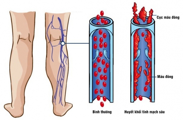 Bệnh huyết khối tĩnh mạch triệu chứng và cách điều trị