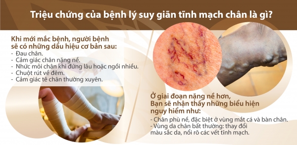 Điều trị suy giãn tĩnh mạch chân hiệu quả theo phương pháp mới