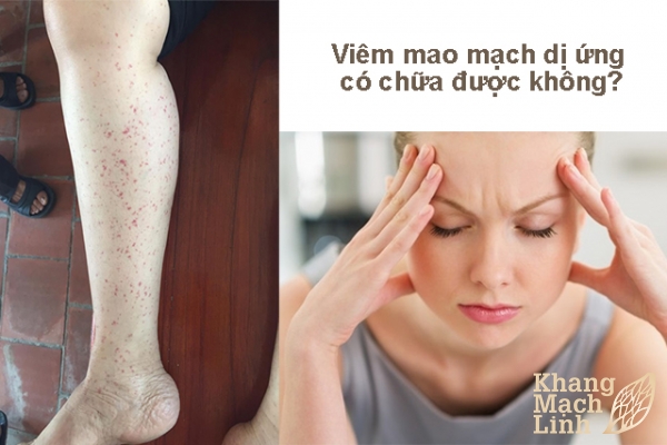 Bác sỹ cho tôi hỏi bệnh mao mạch dị ứng có chữa khỏi được không?