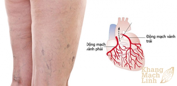 Viêm tắc, suy giãn tĩnh mạch có liên quan đến động mạch vành