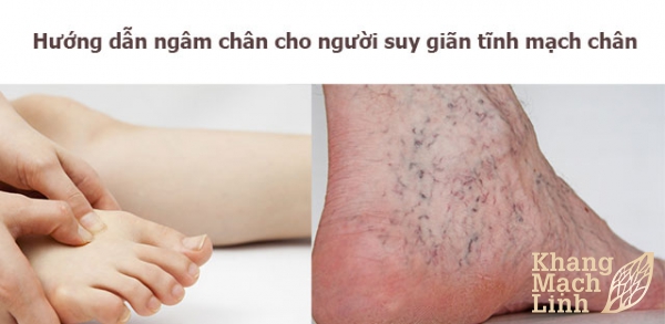 Hướng dẫn ngâm chân cho người suy giãn tĩnh mạch chân